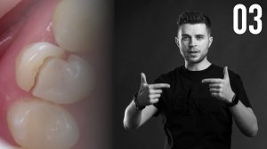 Уроки эндодонтии. Вертикальная фрактура корня