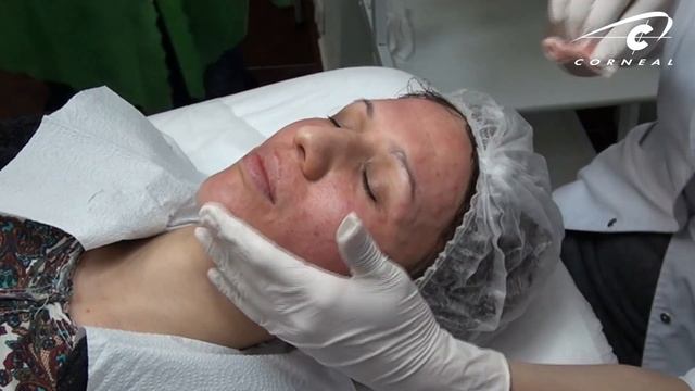 Какую маску выбрать для закрытия биоревитализации смотреть онлайн