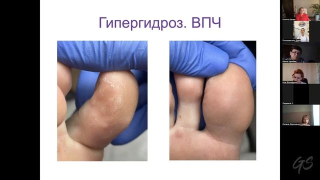 О чем говорят наши стопы трещины, бородавки, кератоз подолог Людмила Левченко смотреть онлайн