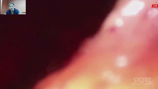 Диастаз, грань между пластической хирургией и герниологией. смотреть онлайн