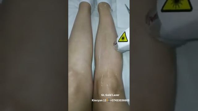 Diode epilation# Դիոդային լազերային էպիլյացիա# смотреть онлайн