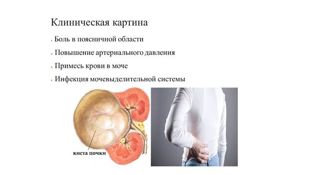 Онлайн-лекция: киста почки смотреть онлайн