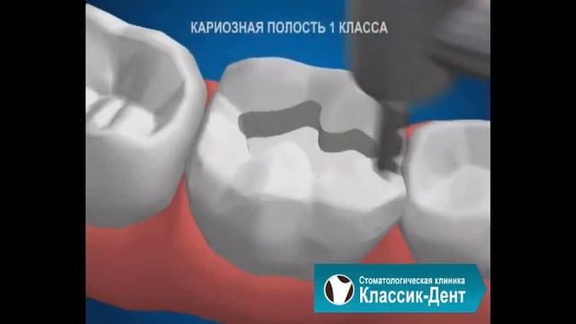 Классик-Дент: Кариозная полость 1й класс смотреть онлайн
