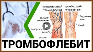 ТРОМБОФЛЕБИТ - ПРИЧИНЫ СИМПТОМЫ ЛЕЧЕНИЕ