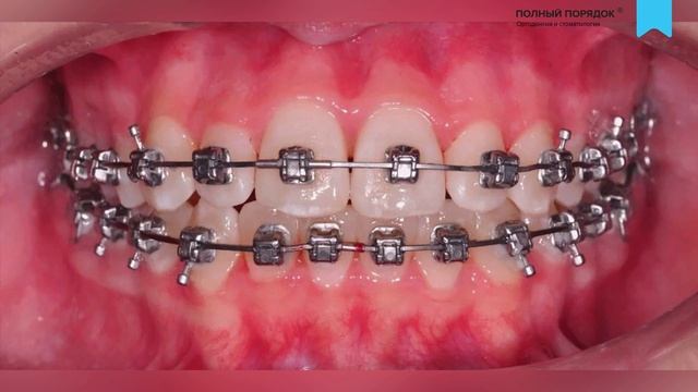 Лечение скученности у подростка на металлических брекетах второго поколения — Damon Q2 смотреть онлайн