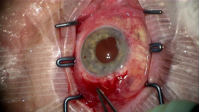 PMMA IOL Removal Iris Repair смотреть онлайн