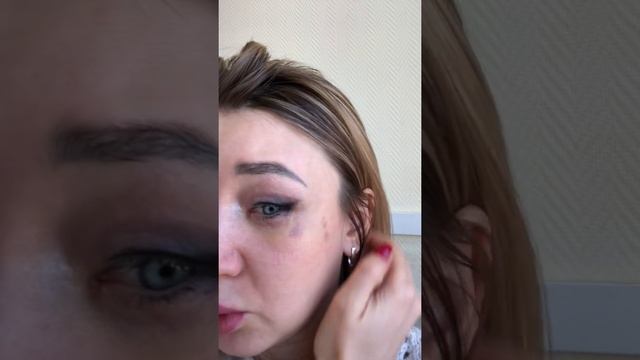 Блефаропластика круговая спустя 10 дней смотреть онлайн