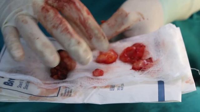 Удаление множественных фиброаденом обеих молочных желёз из параареолярного разреза смотреть онлайн