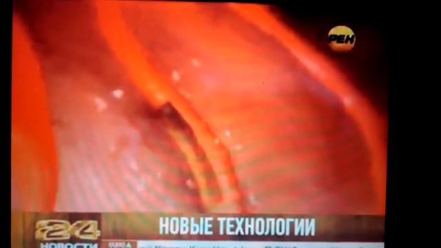 Биорастворимый стент поставили в РКНПК им. Мясникова смотреть онлайн