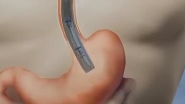 Guardus® overtube: sharp foreign body retrieval animation смотреть онлайн