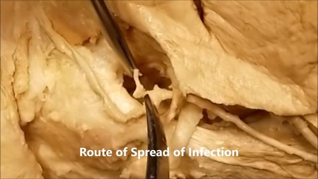 ANGULAR-FACIAL VEIN Tributaries Danger Triangle Face Cavernous Sinus Thrombosis – Sanjoy Sanyal смотреть онлайн