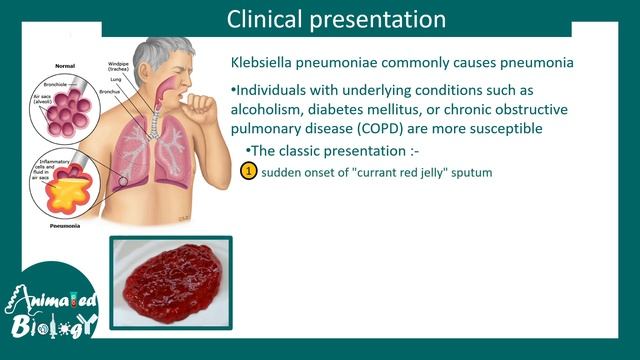 Klebsiella | klebsiella pneumoniae | clinical presentation, risk factors and treatment of Klebsiell смотреть онлайн
