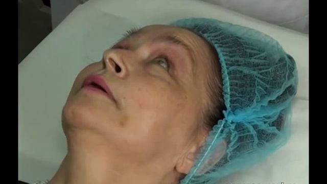 Как сделать пилинг глаз. Пилинг Джеснера и не только. смотреть онлайн