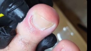 Панариций??⚠️?? • Убираем гнойный мешок???