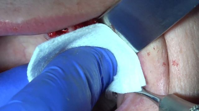 Close Sinus lift using Bond Apatite смотреть онлайн