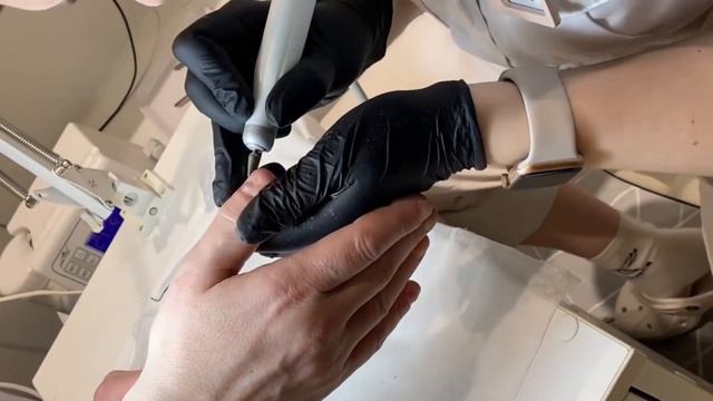 Зачистка онихолизиса 🆘⚠️❗️ смотреть онлайн