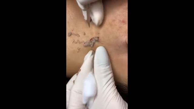 БОЛЬШОЙ ЧИРЕЙ/БОЛЬШОЙ ЧИРЯК/БОЛЬШОЙ ПРЫЩ/БОЛЬШОЙ ГНОЙНИК\МНОГО ГНОЯ