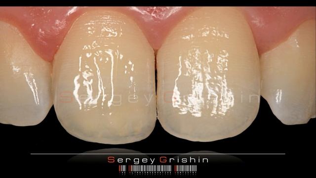 Малоинвазивная реставрация смотреть онлайн