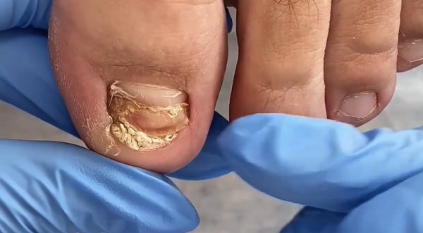 Отдавленные ногти