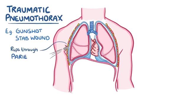 Pneumothorax - Causes, Symptoms, Diagnosis, Treatment, Pathology.mp4
