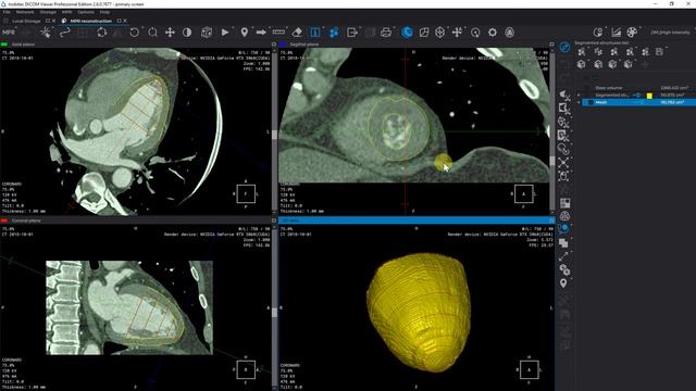 Contouring Tool for segmentation in Inobitec DICOM Viewer Pro. Miocardium case смотреть онлайн