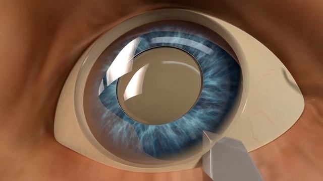 Катаракта лечение