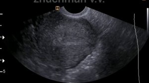 Полип эндометрия УЗИ