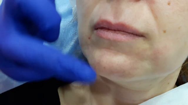 Аириском повышение квалификации по ботоксу ученик из Латвии