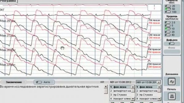 Анализ реографического исследования