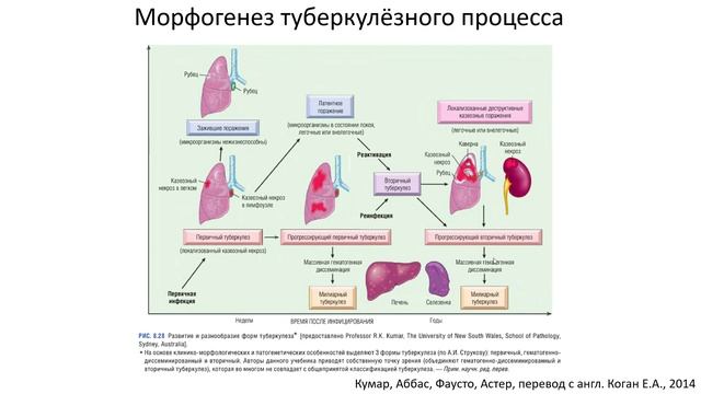 03-03 Туберкулез. Часть 1. Общие характеристики заболевания. Первичный туберкулез. смотреть онлайн