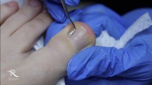 Установка тампонады ligasano