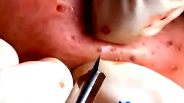 blackhead whitehead & pimple popper blackhead on face смотреть онлайн