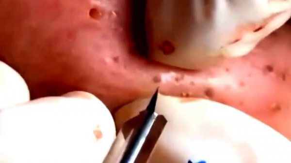 blackhead whitehead & pimple popper blackhead on face