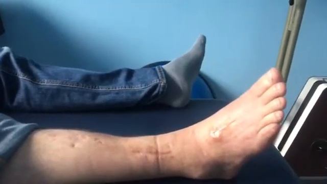 Транспозиція сухожилку задньовеликогомілкового м'яза та розгиначів пальція правої ступні смотреть онлайн