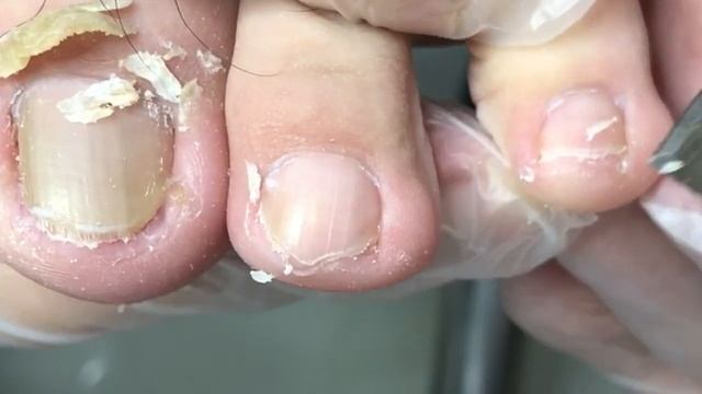 Toenails are a bit inflamed, clean up the ingrown nails【Crazy pedicure room】 смотреть онлайн