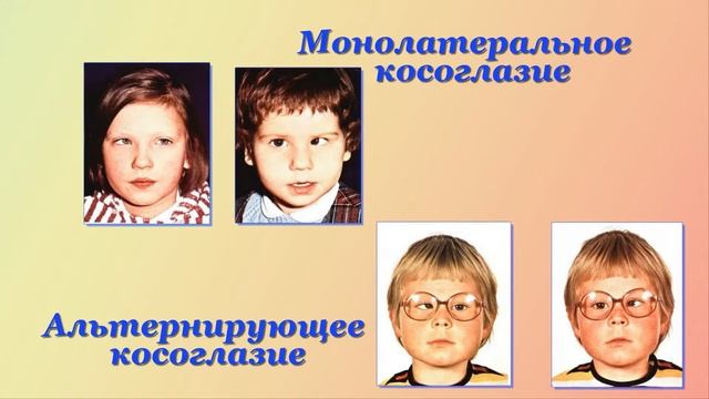 Зрительные диагнозы - амблиопия и косоглазие у детей дошкольного возраста. смотреть онлайн