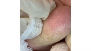 ВЫДАВЛИВАНИЕ ОГРОМНЫХ УГРЕЙ И ПРЫЩЕЙ НА НОСУ!