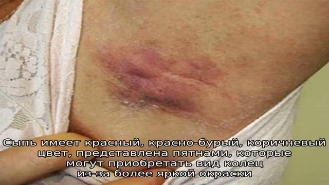 Сыпь в подмышечной впадине смотреть онлайн