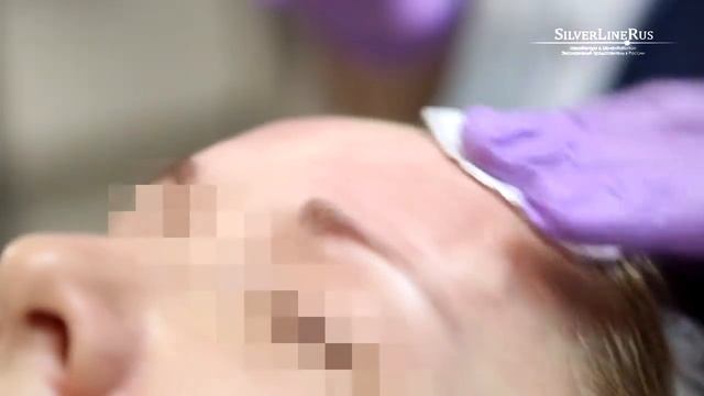 Армирование лба и средней трети лица жидкими нитями. смотреть онлайн