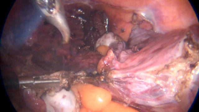 TLH 14 weeks uterus/ Экстирпация матки . Миома 14 нед смотреть онлайн