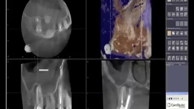 How to read a CBCT (Cone Beam Computed Tomography) Scan смотреть онлайн
