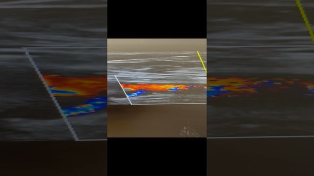 Боли в ногах при ходьбе. Быстрая утомляемость. Атеросклероз. Сосудистый хирург. Флеболог Москва смотреть онлайн