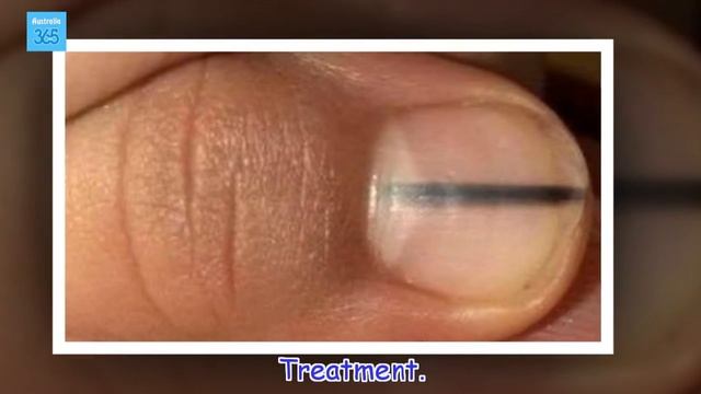 How a Black Line on Your Nails Can Signal Cancer - Australia 365 смотреть онлайн