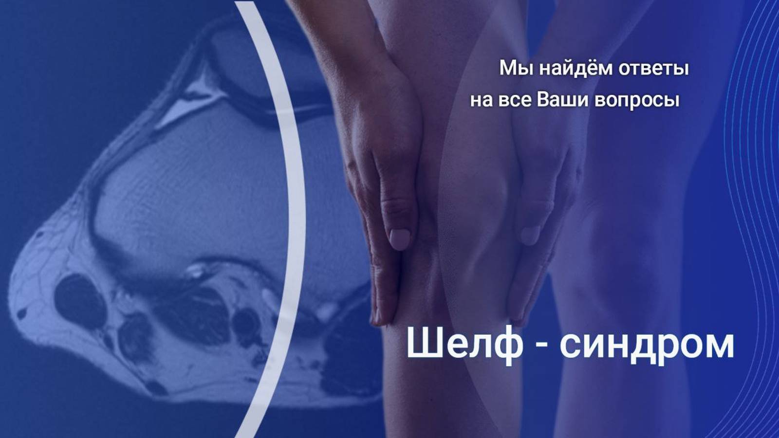 Синдром медиопателлярной складки