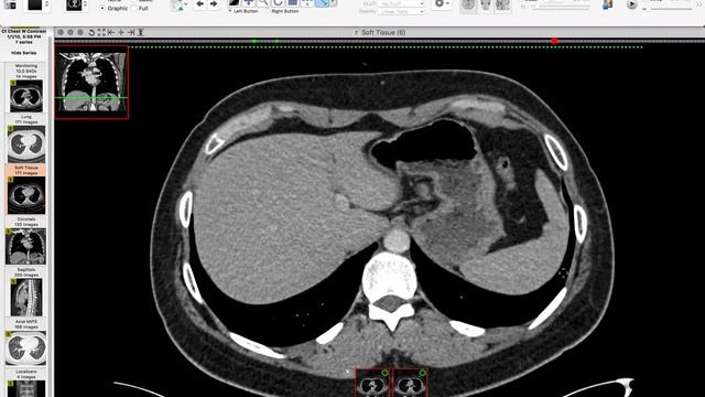 How I Read a Chest CT смотреть онлайн