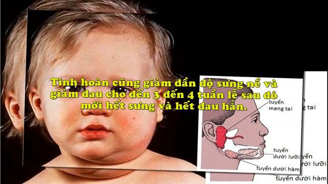 Loại Bỏ Nguy Cơ Hiếm Muộn Do Bệnh Quai Bị