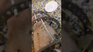 Аппарат Илизаррова : перевязка, обработка ран,спиц