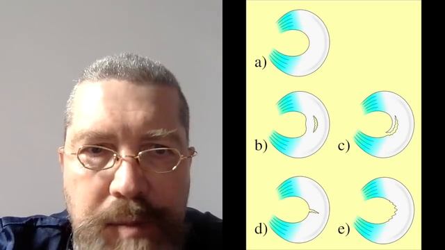 МЕНИСК коленного сустава восстановится без операции, если вы смотреть онлайн