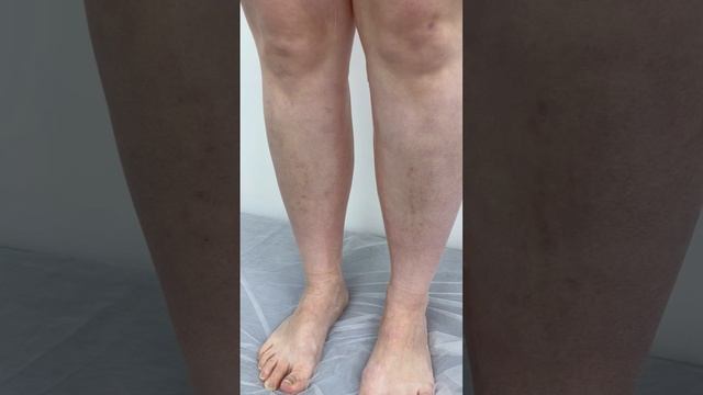 Варикоза нет. Как лечить варикоз? Лечение сосудов. Флеболог Москва. Флеболог смотреть онлайн