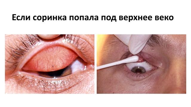 Как удалить соринку из глаза? смотреть онлайн